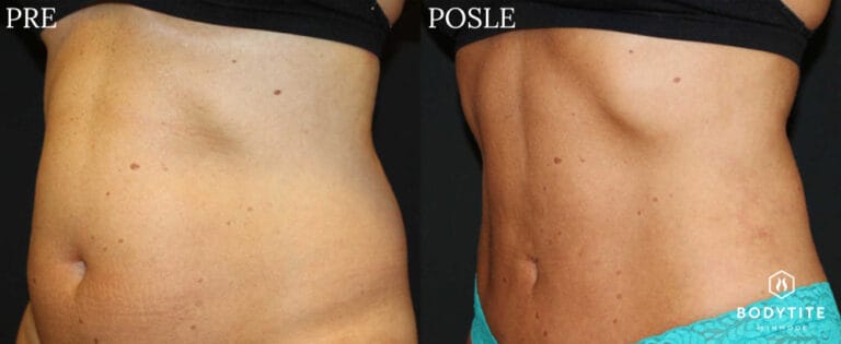 Bodytite - Pre i posle