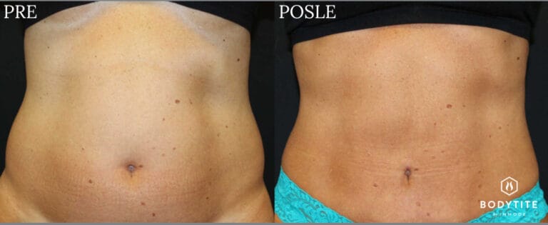 Bodytite - Pre i posle