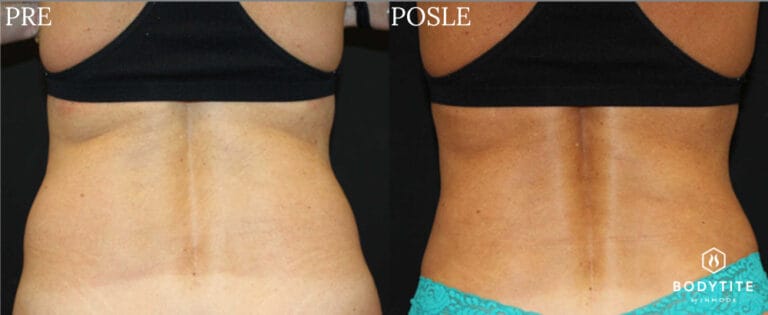 Bodytite - Pre i posle