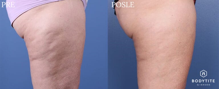 Bodytite - Pre i posle