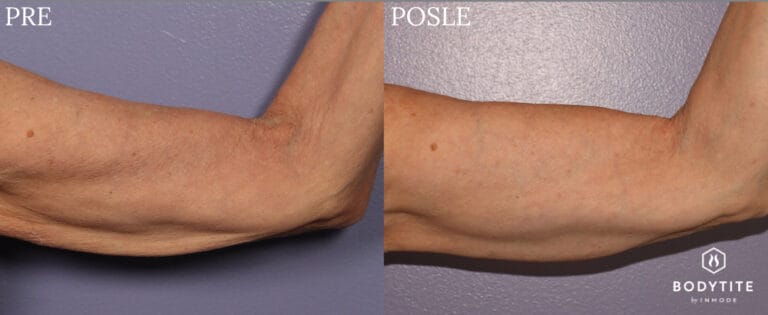 Bodytite - Pre i posle