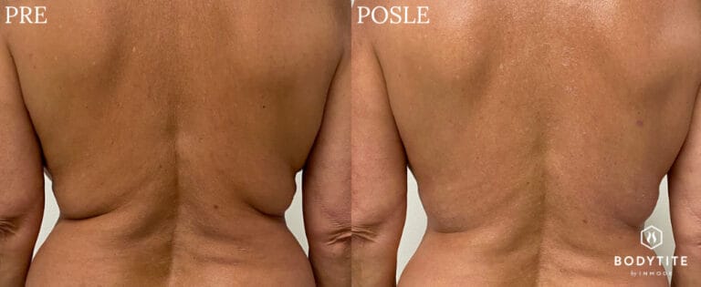 Bodytite - Pre i posle