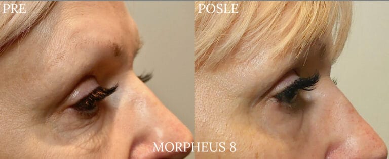 Morpheus 8 - Pre i posle