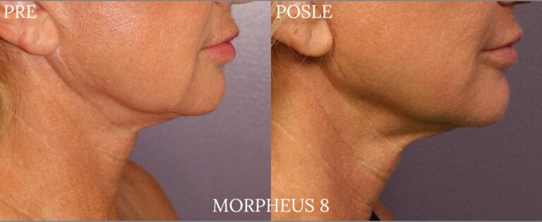 Morpheus 8 - Pre i posle