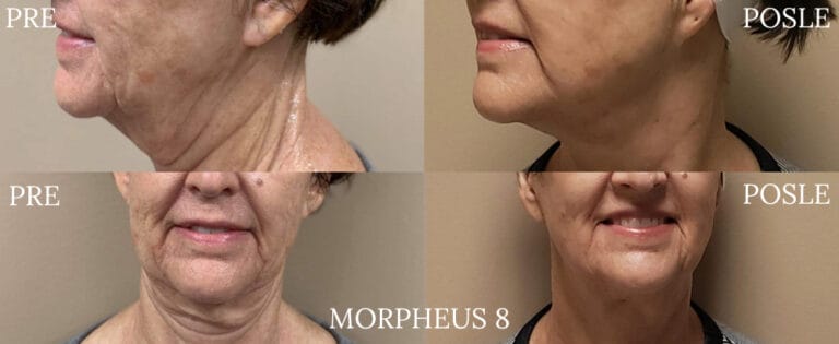 Morpheus 8 - Pre i posle