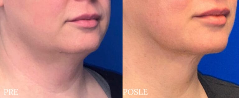 Bodytite - Pre i posle