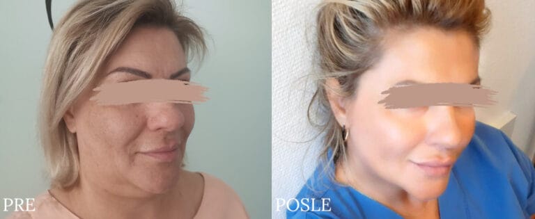 Facelifting - Pre i posle