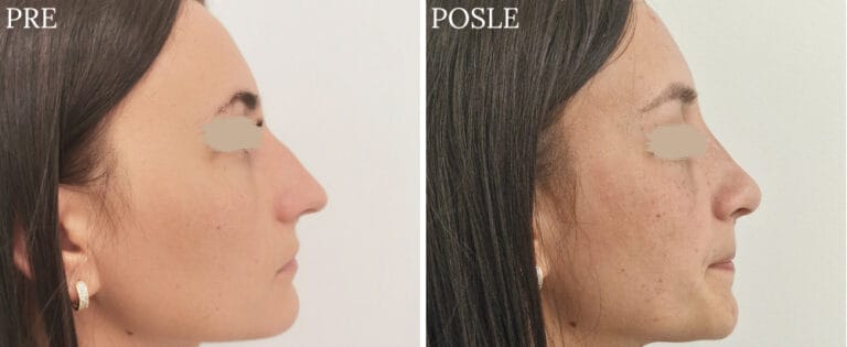 Hirurgija nosa - Pre i posle