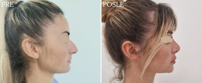 Hirurgija nosa - Pre i posle
