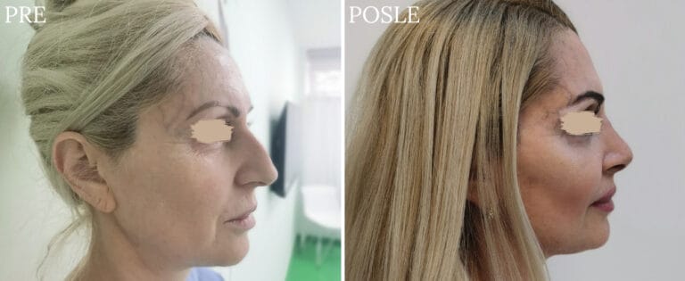 Hirurgija nosa - Pre i posle