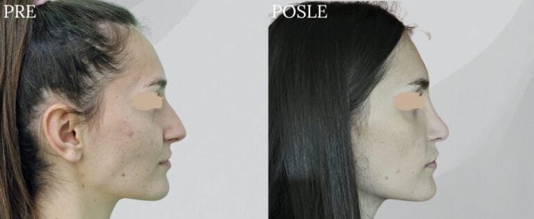 Hirurgija nosa - Pre i posle