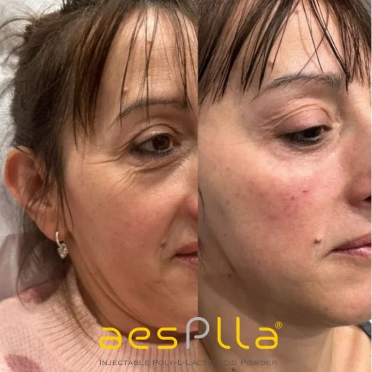 aesplla tretman slika smeđe žene pre i posle