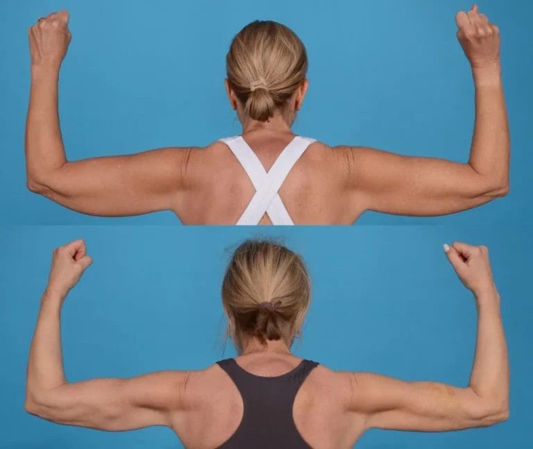 BodyTite kao rešenje za opuštenu kožu nadlaktica