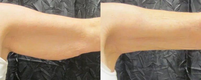 BodyTite kao rešenje za opuštenu kožu nadlaktica