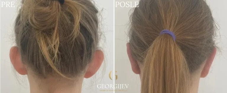 korekcija ušiju - Pre i posle