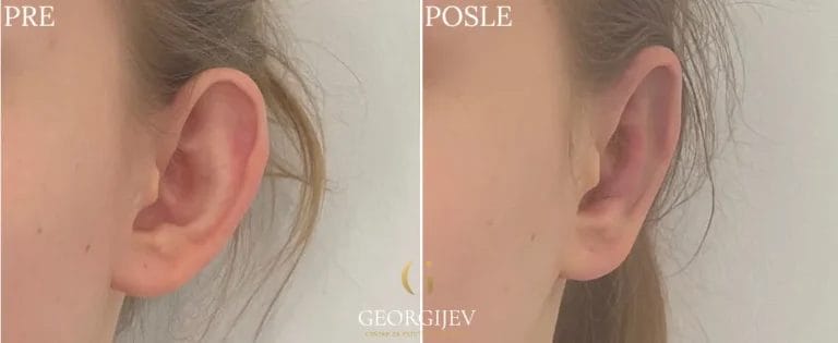 korekcija ušiju - Pre i posle