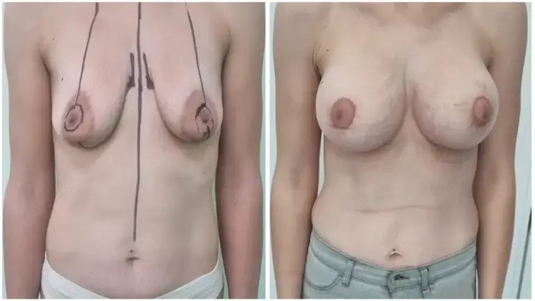 Podizajne-i-uvecanje-grudi-03