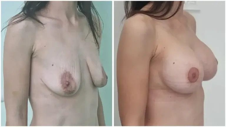 Podizajne-i-uvecanje-grudi-04