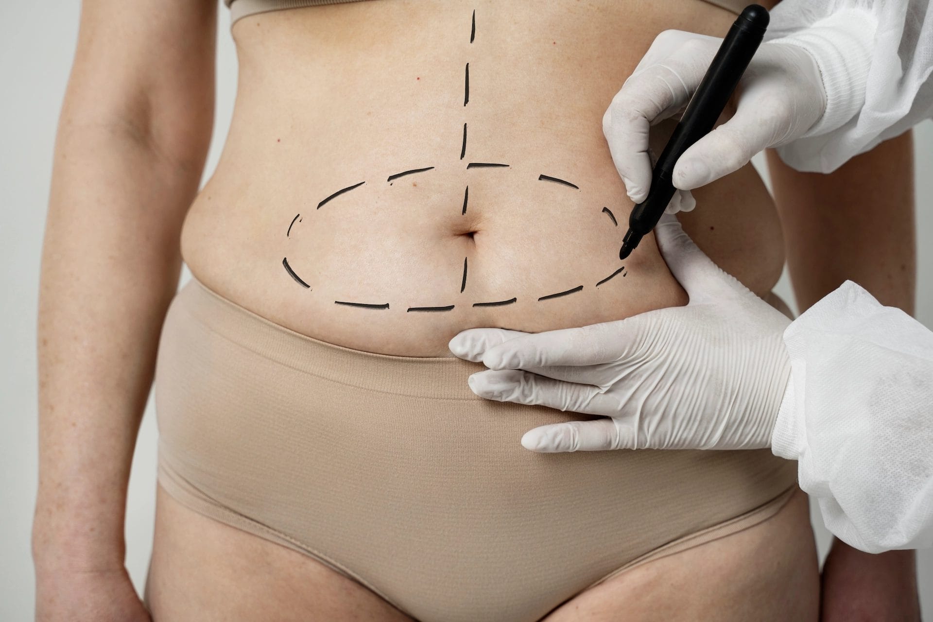 Kada ne trebate uraditi liposukciju? Preporuke i razlozi za odlaganje zahvata